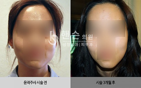 윤곽주사 전후사진 입니다. 