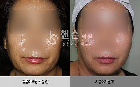 얼굴리프팅 전후사진 입니다. 