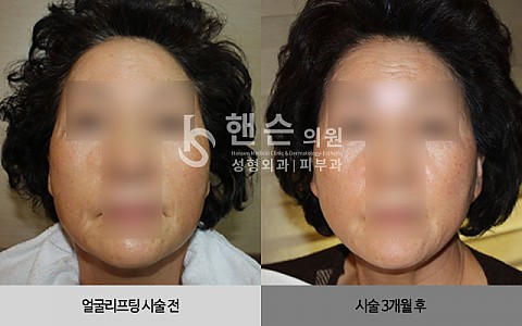 얼굴리프팅 전후사진 입니다. 