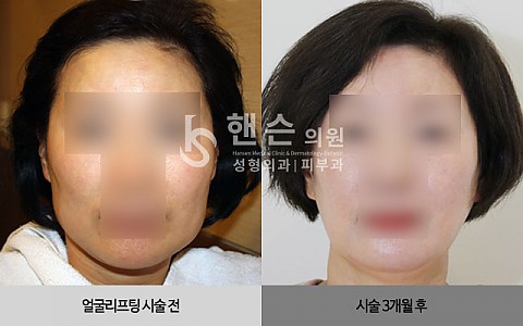 얼굴리프팅 전후사진 입니다. 