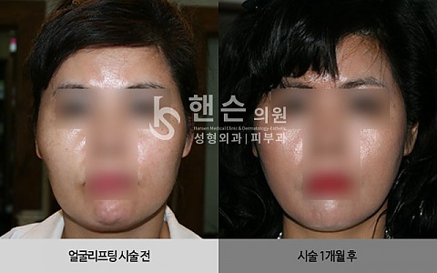 얼굴리프팅 전후사진 입니다. 