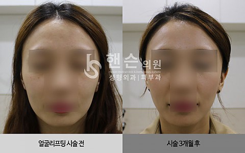 얼굴리프팅 전후사진 입니다. 