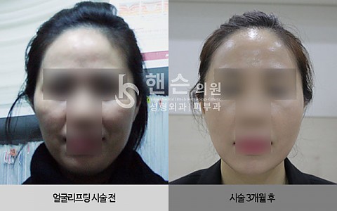 얼굴리프팅 전후사진 입니다. 