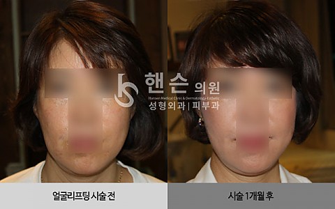 얼굴리프팅 전후사진 입니다. 