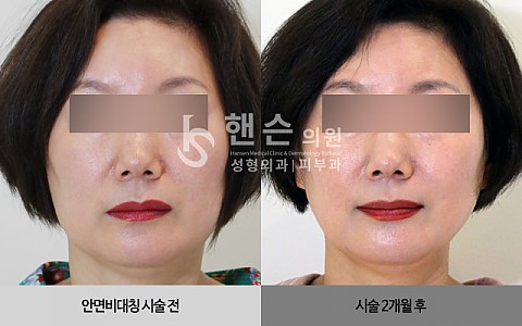 안면비대칭 교정 전후사진입니다. 