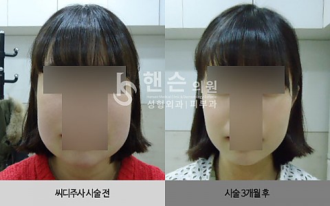 씨디주사 전후사진입니다. 