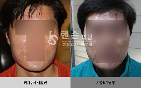 씨디주사 전후 사진입니다. 