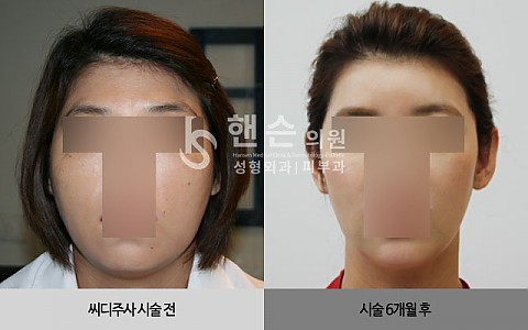 씨디주사 전후 사진입니다. 