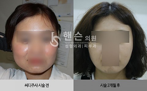 씨디주사 전후 사진입니다. 