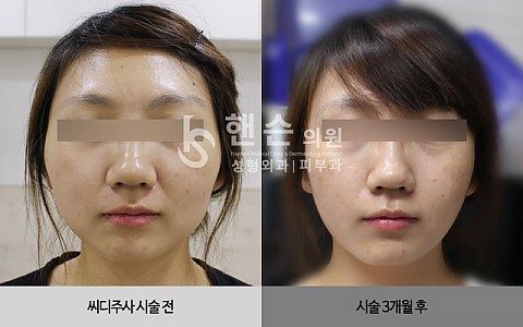 씨디주사 전후 사진입니다. 