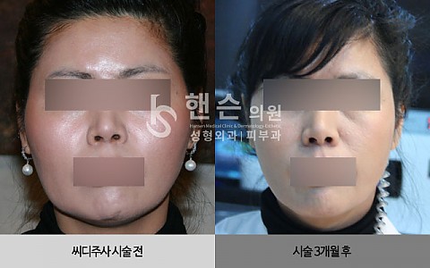 씨디주사 전후 사진입니다. 