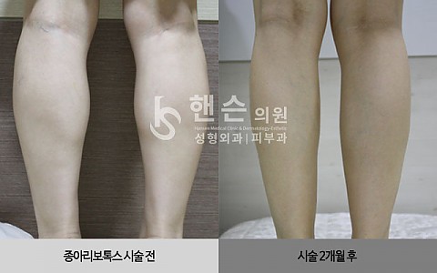 종아리보톡스 전후사진 입니다. 