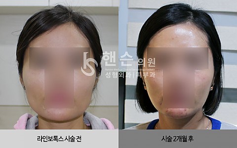 라인보톡스 전후사진 입니다. 