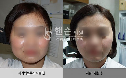 사각턱보톡스 전후사진 입니다. 
