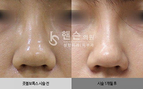 콧볼보톡스 전후사진입니다 