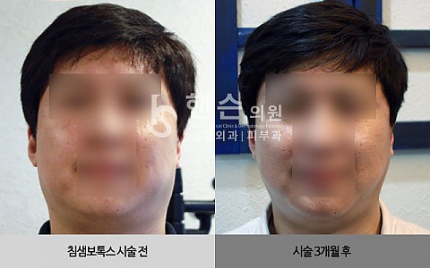 침샘보톡스 전후사진 입니다. 