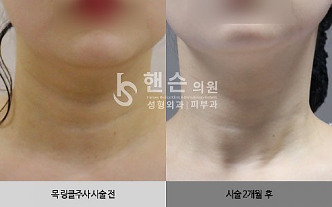 큐링클주사 전후사진입니다 