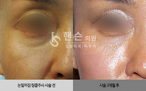 큐링클주사 전후사진입니다 