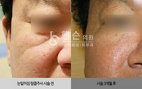 큐링클주사 전후사진입니다 