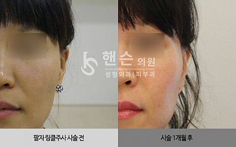 큐링클주사 전후사진입니다 
