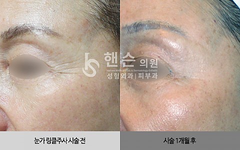 큐링클주사 전후사진입니다 