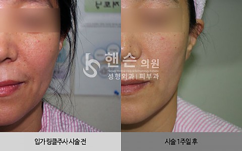 큐링클주사 전후사진입니다 