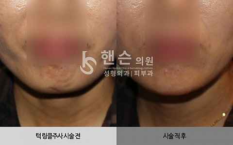 큐링클주사 전후사진입니다 