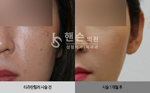 리쥬란힐러 전후사진 입니다 