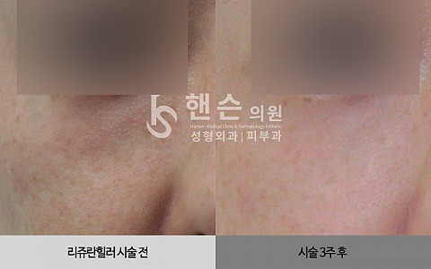 리쥬란힐러 전후사진 입니다 