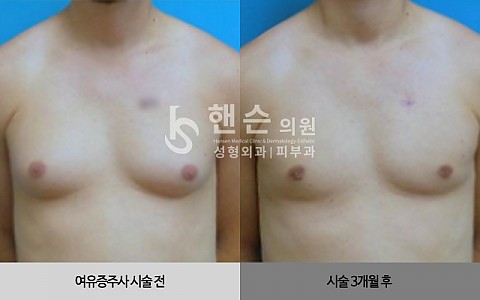 여유증주사 전후사진입니다 