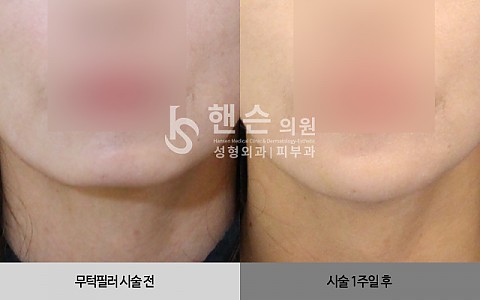 무턱필러 시술 전후사진입니다. 