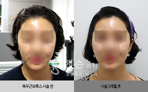 측두근보톡스 시술 전후입니다. 