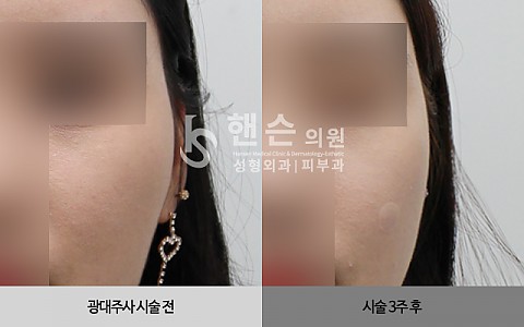 광대주사 전후사진입니다. 