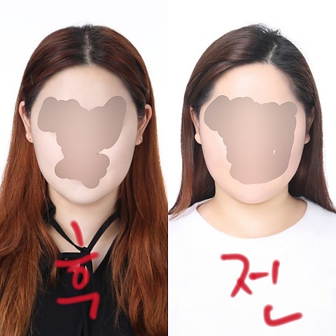 셀피주사(옆광대,심부볼)후기~~!! 