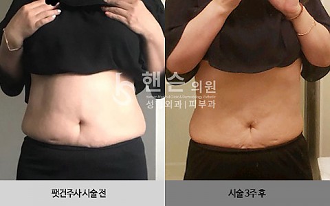 팻건주사 