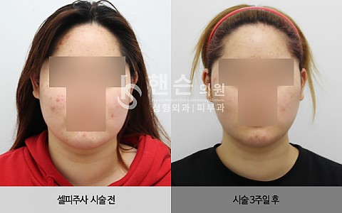 셀피주사 전후사진 입니다 