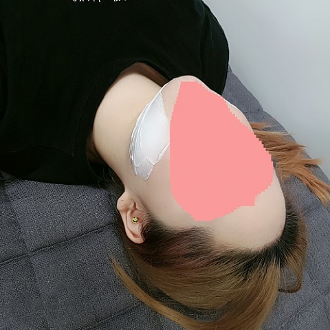핸슨의원 셀피주사(옆광대,심부볼,이중턱) 리얼후기~~ 
