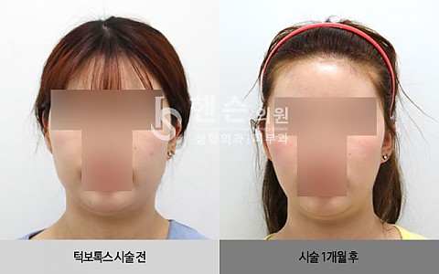 턱보톡스 전후사진 입니다 