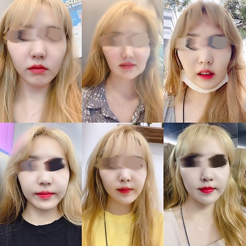 셀피주사 핵대박 (셀피3부위, 입꼬리보톡스, 자갈턱보톡스  비대칭맞추기) 