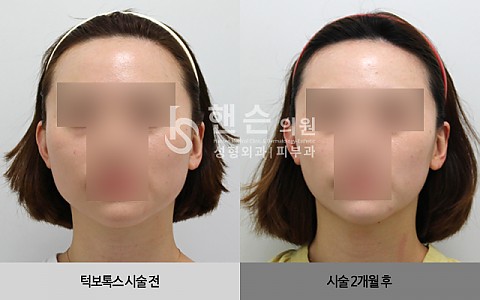 턱보톡스 전후사진입니다. 