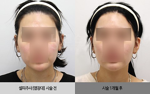 셀피주사[옆광대] 전후사진 입니다. 