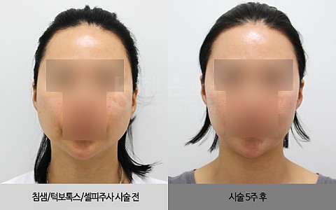 침샘보톡스, 턱보톡스, 셀피주사 전후사진입니다. 