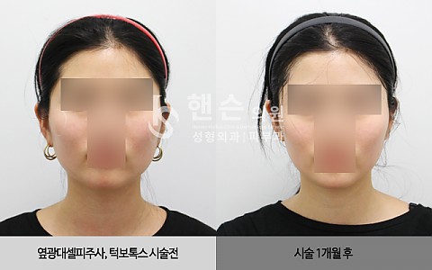 턱보톡스, 옆광대주사[셀피주사] 전후사진입니다. 