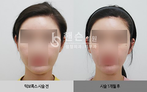 턱보톡스 전후사진입니다. 