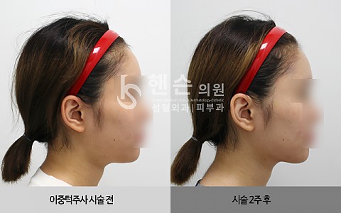 셀피주사[이중턱]전후사진 입니다. 