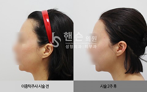 셀피주사[이중턱] 전후사진입니다. 