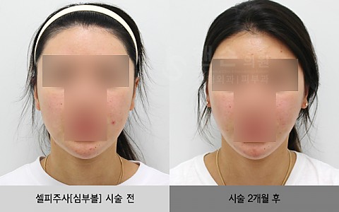 셀피주사[심부볼] 전후사진입니다. 