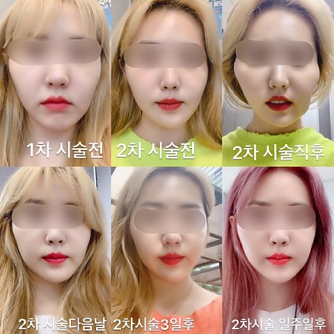 비대칭 셀피 주사 2차 시술 후기도 대만족 