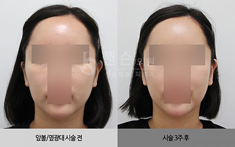 셀피주사[앞볼/옆광대] 시술 전후사진 입니다. 