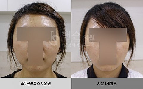 측두근보톡스 전후사진입니다 